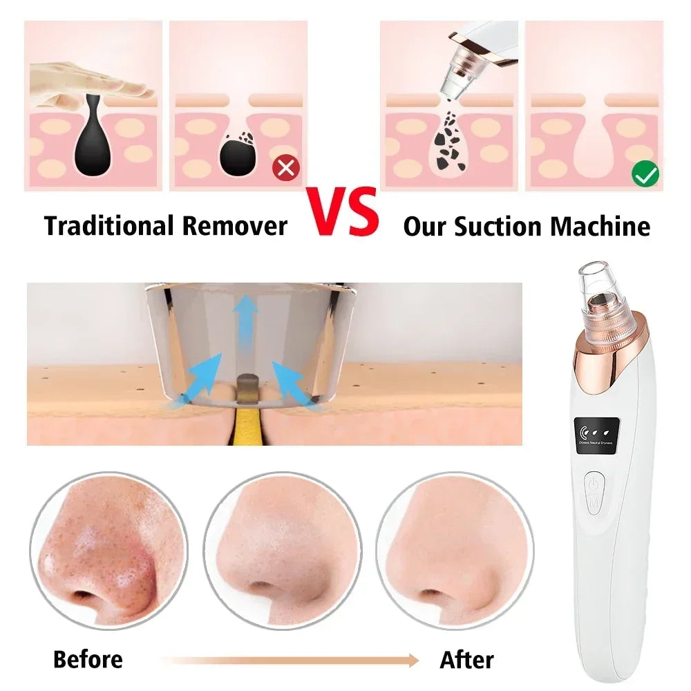 Revolutionize Your Skin Care Routine with Our Electric Blackhead Remover – USB Facial Pore Cleaner for Spotless Skin and Acne-Free Complexion!